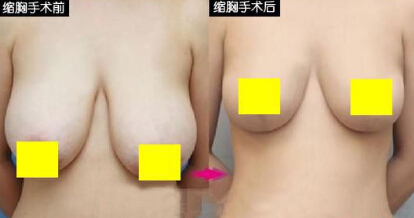 内江乳房缩小术多少钱