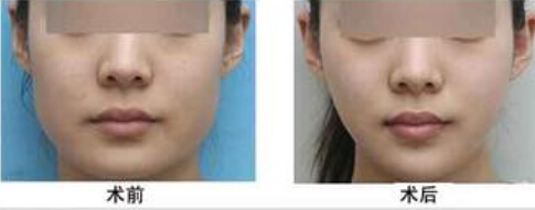 圆脸改瓜子脸