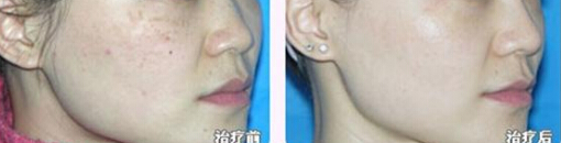 达州光子嫩肤有副作用吗