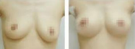 乳房下坠怎么办呢