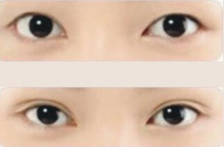 成都哪里做双眼皮手术好