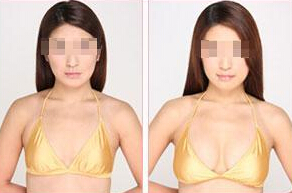 假体丰胸效果可以维持多久