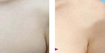 做什么运动能减掉副乳