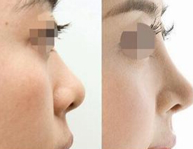 女人鼻子短怎么办