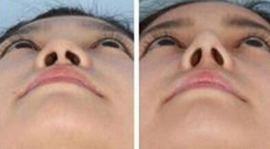 朝天鼻矫正