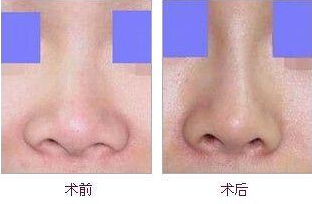 膨体隆鼻效果可以维持多久