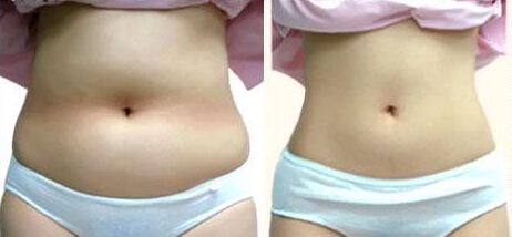 腹部吸脂会影响生育吗