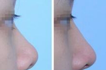 朝天鼻整形术后要怎样护理