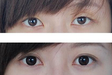 割双眼皮后看得出疤痕吗