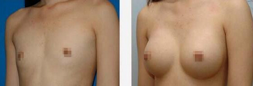女人隆胸会损伤乳腺吗