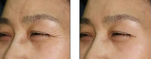 注射除皱的方法有哪些呢