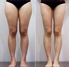 瘦小腿的方法有哪些