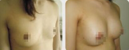 乳晕发黑如何变红