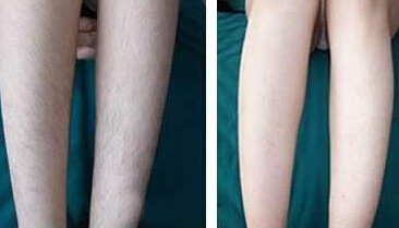 小腿激光脱毛有用吗