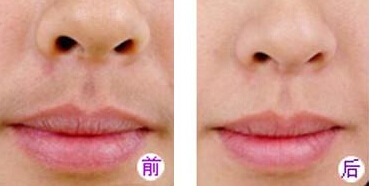 女生有胡子怎么办