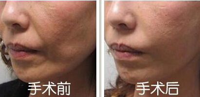 女人脸太瘦怎么办才好