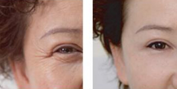 去鱼尾纹能用胶原蛋白吗