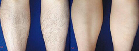 成都做激光去腿毛多少钱