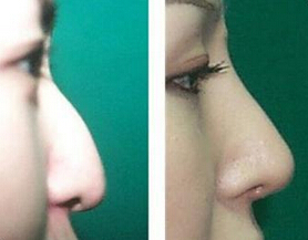 驼峰鼻整形的注意事项