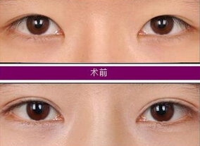 双眼皮手术疤痕明不明显