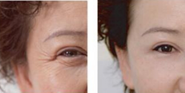 去除眼纹快速有效的办法