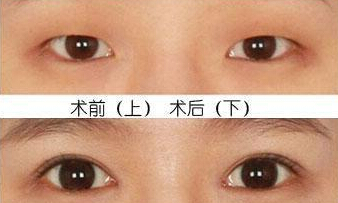 重睑术会伤害眼睛吗