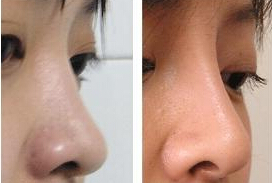 一般假体隆鼻费用要多少
