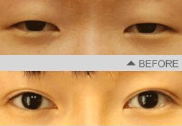 女人眼皮松弛下垂怎么办