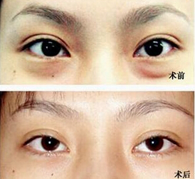 怎样才能去黑眼圈