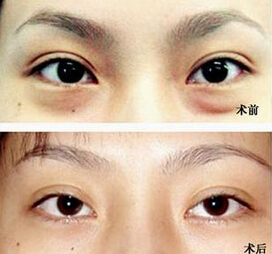 如何祛黑眼圈