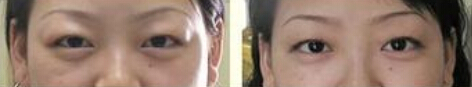 上眼皮抽脂好么