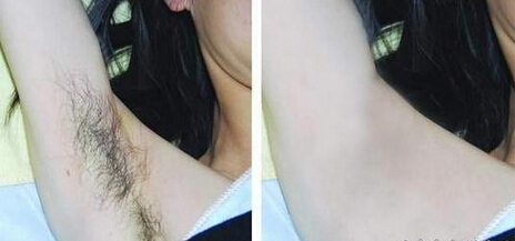 成都光子脱毛痛吗