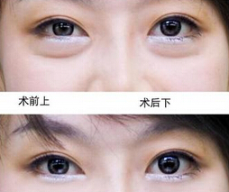 一般眼袋切除后还会长吗
