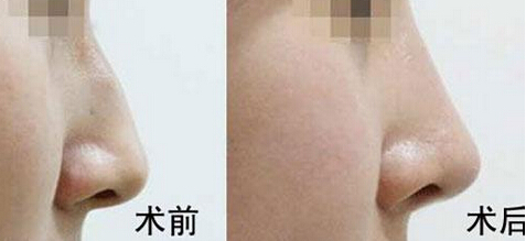 成美专家全面解析驼峰鼻整形术