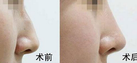 驼峰鼻该怎样治疗