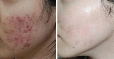 消灭痘痘 快找汉方祛痘术