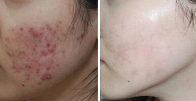 女生怎样快速祛痘