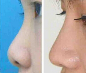 膨体隆鼻优越性是什么