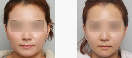 磨颧骨能让脸变小吗