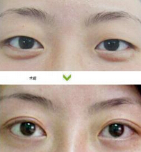 埋线重睑术自然吗