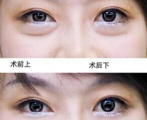 如何去眼袋好