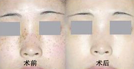 怎样去色素斑