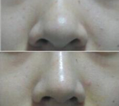 鼻梁骨宽怎么办好