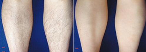 男人腿毛多可以脱毛吗