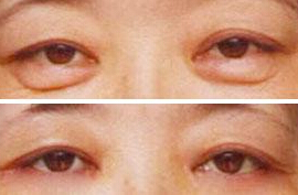 眼部吸脂手术有什么优点