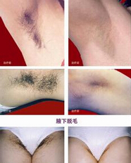 激光脱毛能管多久