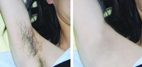 冰肌脱毛多少钱
