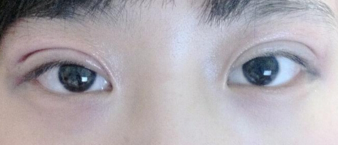 双眼皮埋线好么