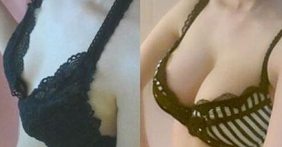 硅胶假体丰胸好不好
