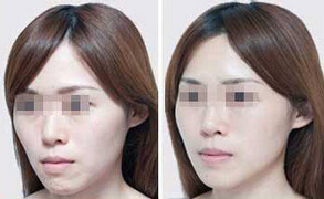 一般玻尿酸丰脸多少钱
